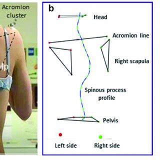 (a) Palpation of spinal curvature with A-palp; (b) Representation of ...