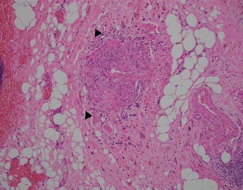 A Hande X10 High Power View Of Boxed Area Demonstrating Metastatic