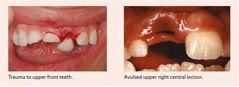 Tooth Pulp Infection