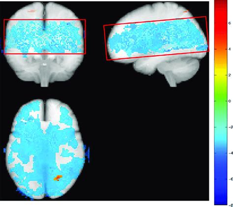 Effect Of Hemoglobin On Regional Cbf Glass Brain Representation Of