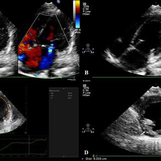 A Bidimensional And Color Doppler Echocardiography Apical Four