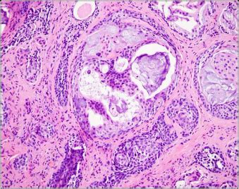 Clinical Pathologic Conference Case Long Standing Nodule Of Upper