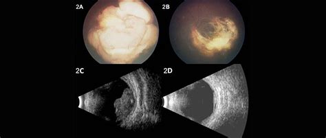 Ultrassonografia Ocular Ou Ecografia Clinica De Olhos Quinellato