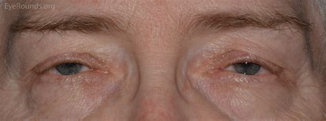 A Primer On Ptosis