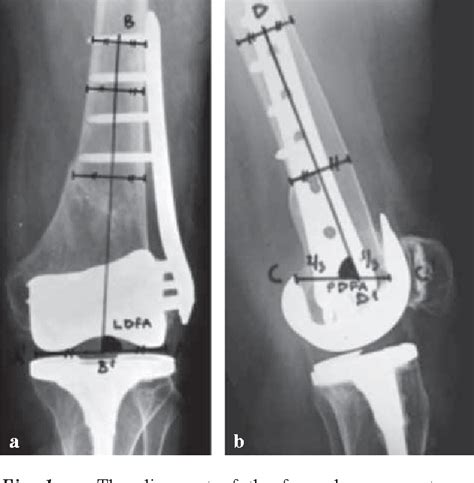 Figure 1 From Comparison Of Locked Plating And Intramedullary Nailing