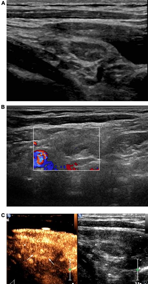 Frontiers Value Of Contrast Enhanced Ultrasound In The Ultrasound