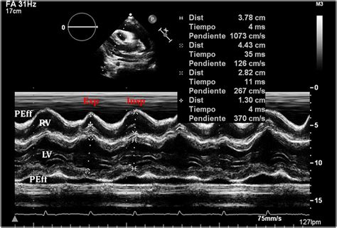 Frontiers Echocardiographic Evaluation Of Pericardial Effusion And