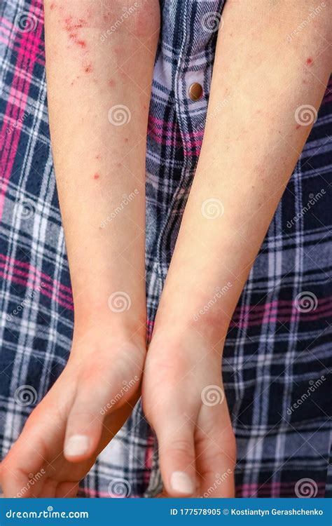 Une Dermatite Atepic De Blessures Entre Les Mains D Un Enfant Image