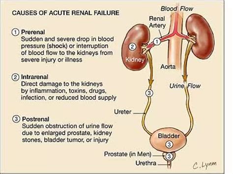 Renal Failure | PPT