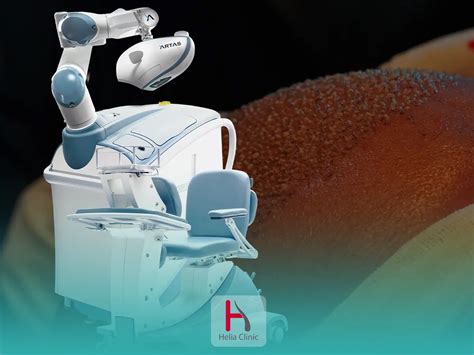 ARTAS Robotic Hair Transplant: Precision Control and Minimally Invasive ...