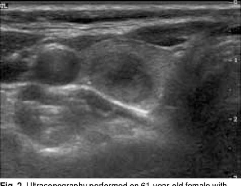 Medullary Carcinoma Thyroid Ultrasound