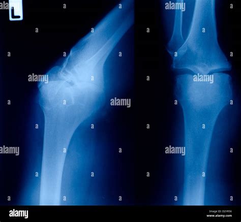 Xray Showing Right Knee Osteoarthritis Stock Photo Alamy