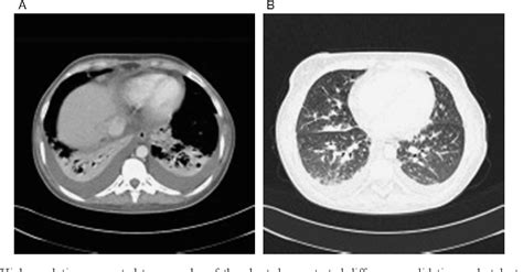 Figure From Cytomegalovirus Pneumonitis In A Patient With Homozygous