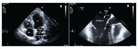 Cor Triatriatum Treatment And Management Point Of Care