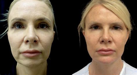 Chin Jawline Filler Pittsburgh Pa Beleza Plastic Surgery Medical Spa