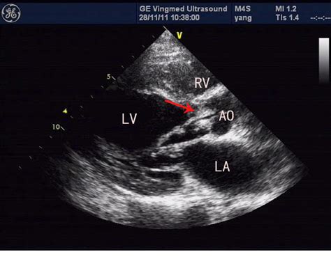 Erysipelothrix Rhusiopathiae Induced Aortic Valve Endocarditis Case