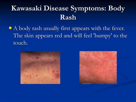 PPT - KAWASAKI DISEASE PowerPoint Presentation, free download - ID:224841