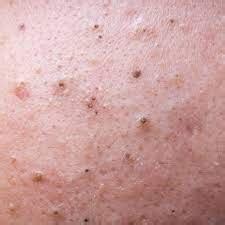 Warning The Risks And Considerations Of Popping Infected Blackheads