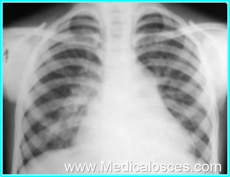 Atrial Septal Defect Asd X Ray Medical Osces