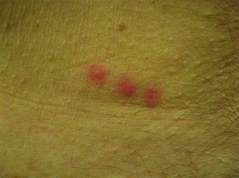 Bedbugs - Dermatologic Disorders - Merck Manual Professional Edition