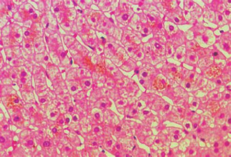 Histopathology Of The Liver Biopsy Specimen In The Dubin Johnson