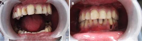 Post Operative Instructions After Gic Restoration Online Ststephen Pc