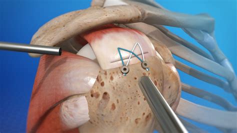 Shoulder Arthroscopy for Rotator Cuff Tears | Shoulder Keyhole Surgery