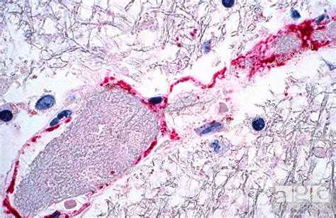 Using Immunohistochemical Ihc Technique This Photomicrograph Of A