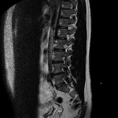 Hernia mea de disc Poze RMN pozeee RMN IRM după 3 ani