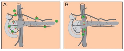 Lymph Nodes Of The Pancreas A Groups Of Lymph Nodes That Outline The