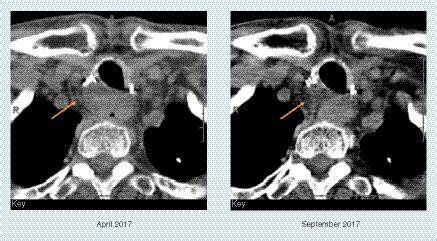 Full Article Therapy With Tyrosine Kinase Inhibitor Lenvatinib In