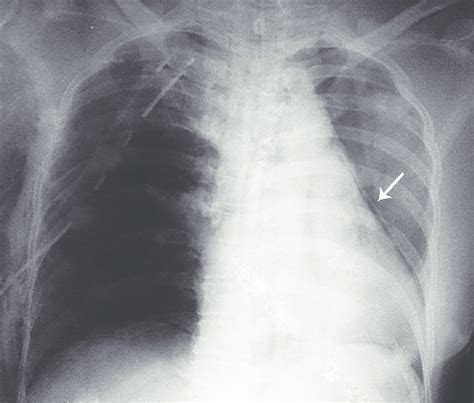 Posterior To Anterior Chest Radiography Showing Air Entrapment In The