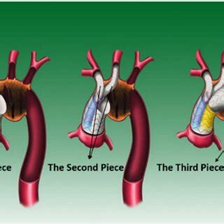 Diagram of the MIBSG. | Download Scientific Diagram