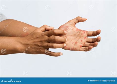 Black Woman Scratching Itch On Her Hand Stock Image Image Of Fungal