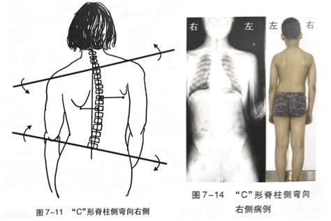 体态评估脊柱侧弯姿势评估与解剖学分析 知乎