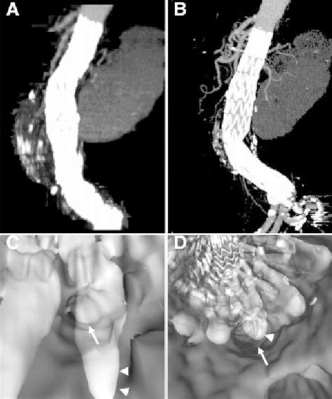 Figure From Three Dimensional Visualization Of Suprarenal Aortic