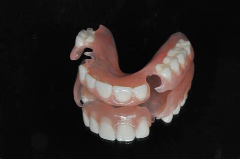 Flexible partial denture upper front teeth | Hummingbird Dental | Voted ...