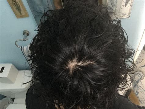 Can someone please let me know if im balding. M 19. Both my parents and