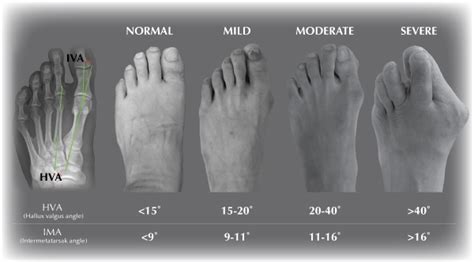 Hallux Valgus Bunion