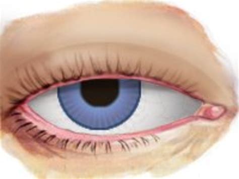 Burst blood vessel in eye – Symptoms, Causes, Treatment