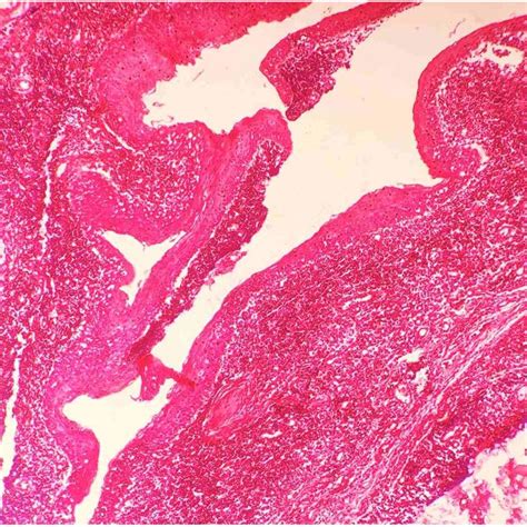 The Histopathological Finding Showed The Cyst Wall Was Lined By