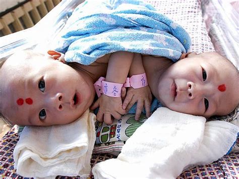 Conjoined twins: 40 amazing photos (GRAPHIC IMAGES) - Photo 9 ...