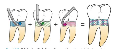 Subgingival Calculus Removal And Stains And Discoloration Flashcards