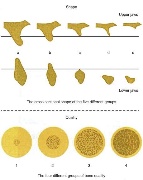 factors involved  single implants pocket dentistry