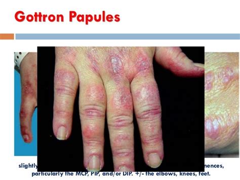 treatment  resistant relapsing polymyositis dm