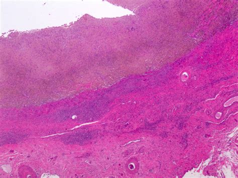 pathology outlines endometriosis