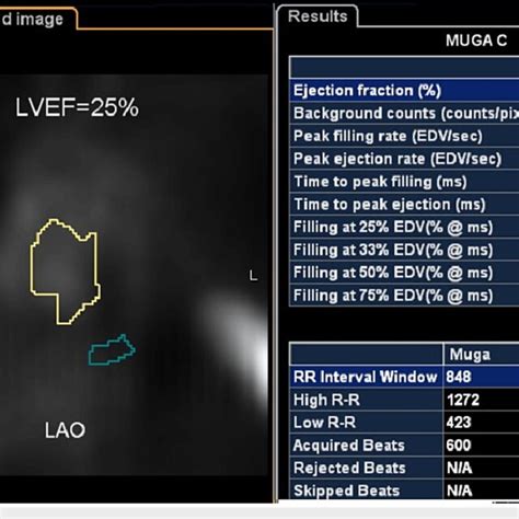 Muga Scan Of The Patient Before Icd Crt D Implantation Muga