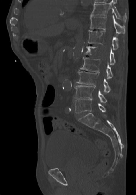 Multiple myeloma | Applied Radiology