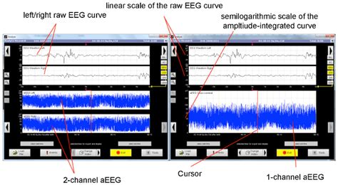 Application Of An Amplitude Integrated Eeg Monitor Cerebral Function