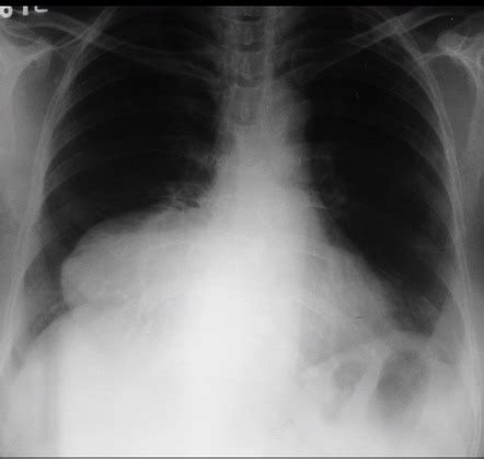 Pericardial cyst | Radiology Reference Article | Radiopaedia.org